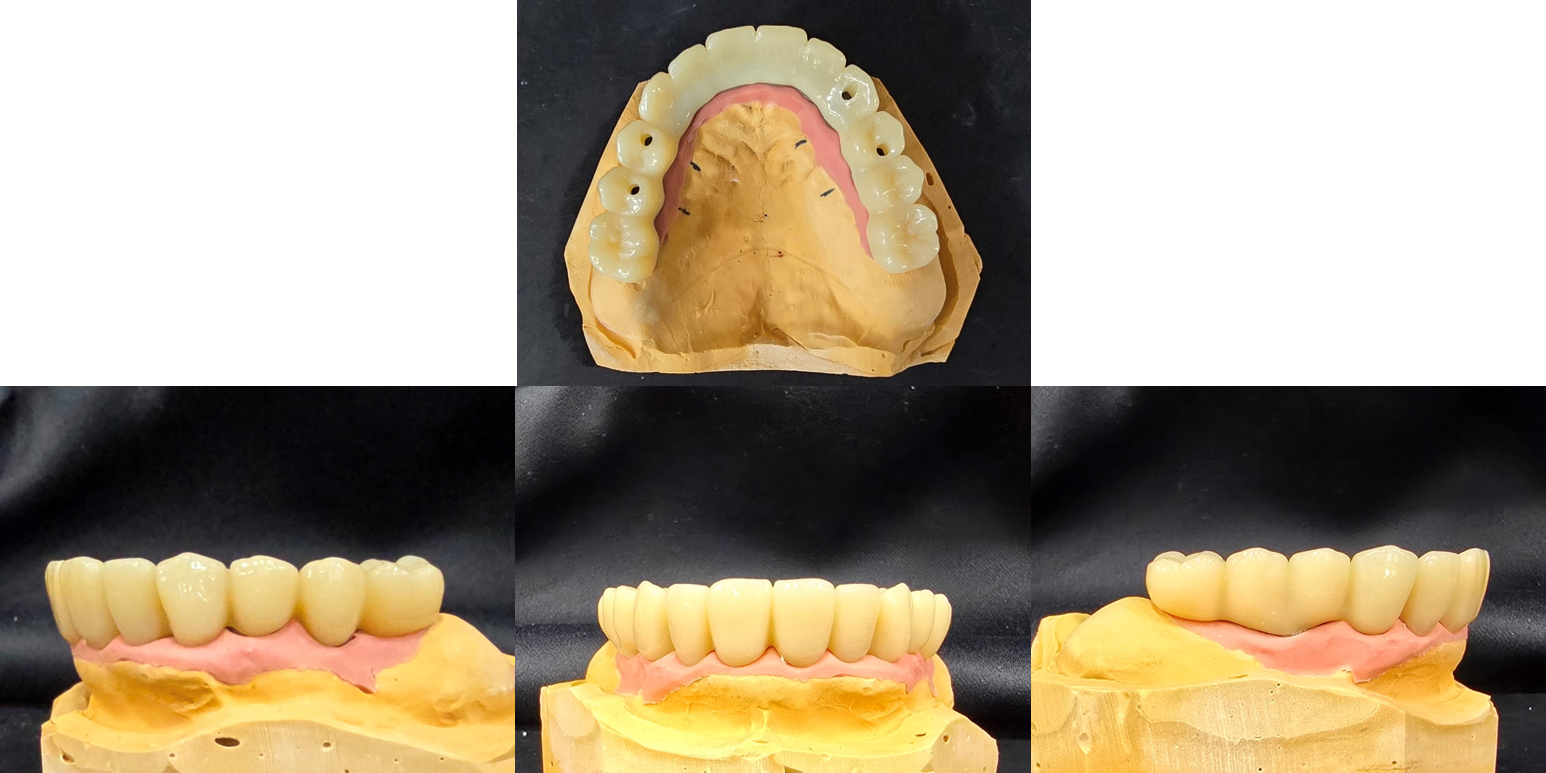 한솔치과기공소 작품 5
